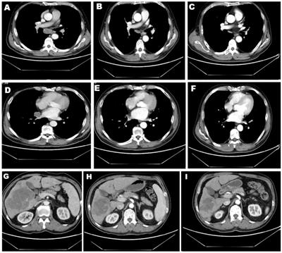 Case Report: A novel intergenic MIR4299/MIR8070-RET fusion with RET amplification and clinical response to pralsetinib in a lung adenocarcinoma patient